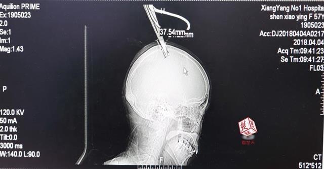18岁流白浆原因-生理现象还是需要治疗-荟 示例图 - 说明文字
